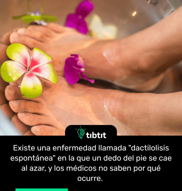 Existe una enfermedad llamada "dactilolisis espontánea" en la que un dedo del pie se cae al azar, y los médicos no saben por qué ocurre.