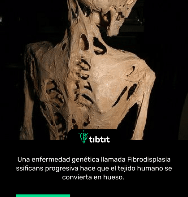 Una enfermedad genética llamada Fibrodisplasia ssificans progresiva hace que el tejido humano se convierta en hueso.