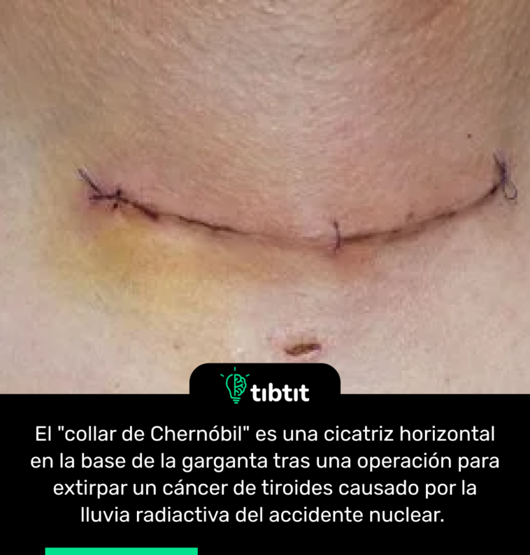 El "collar de Chernóbil" es una cicatriz horizontal en la base de la garganta tras una operación para extirpar un cáncer de tiroides causado por la lluvia radiactiva del accidente nuclear.