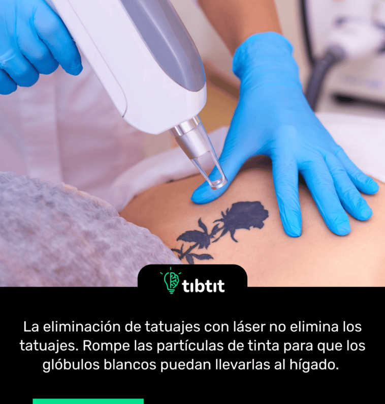 La eliminación de tatuajes con láser no elimina los tatuajes. Rompe las partículas de tinta para que los glóbulos blancos puedan llevarlas al hígado.