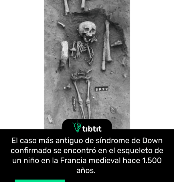 El caso más antiguo de síndrome de Down confirmado se encontró en el esqueleto de un niño en la Francia medieval hace 1.500 años.