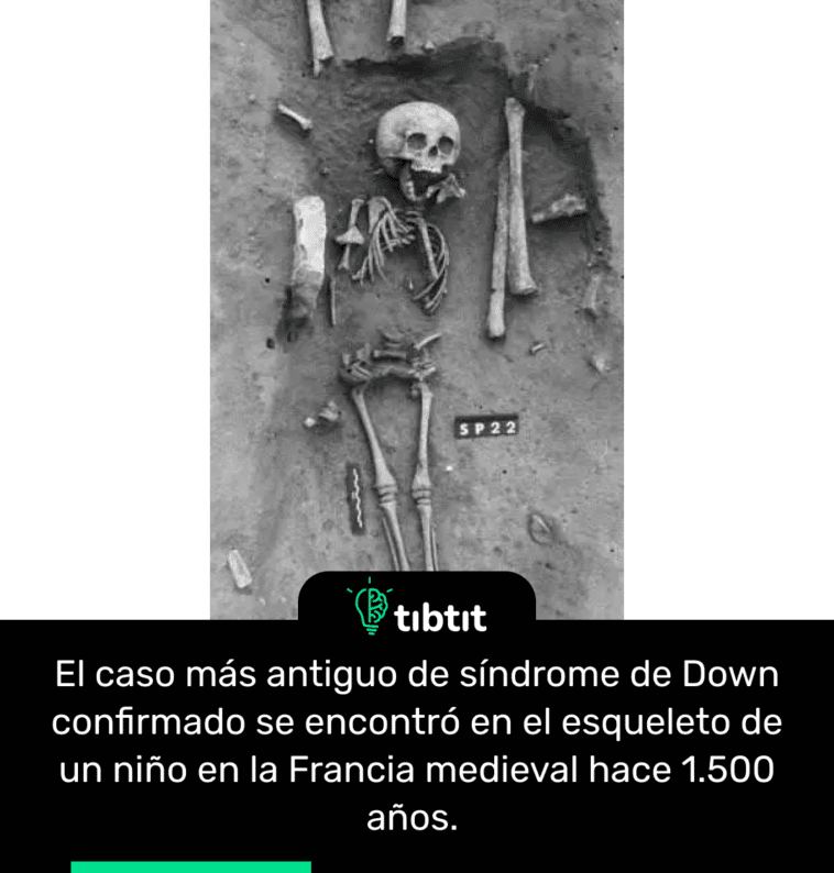 El caso más antiguo de síndrome de Down confirmado se encontró en el esqueleto de un niño en la Francia medieval hace 1.500 años.