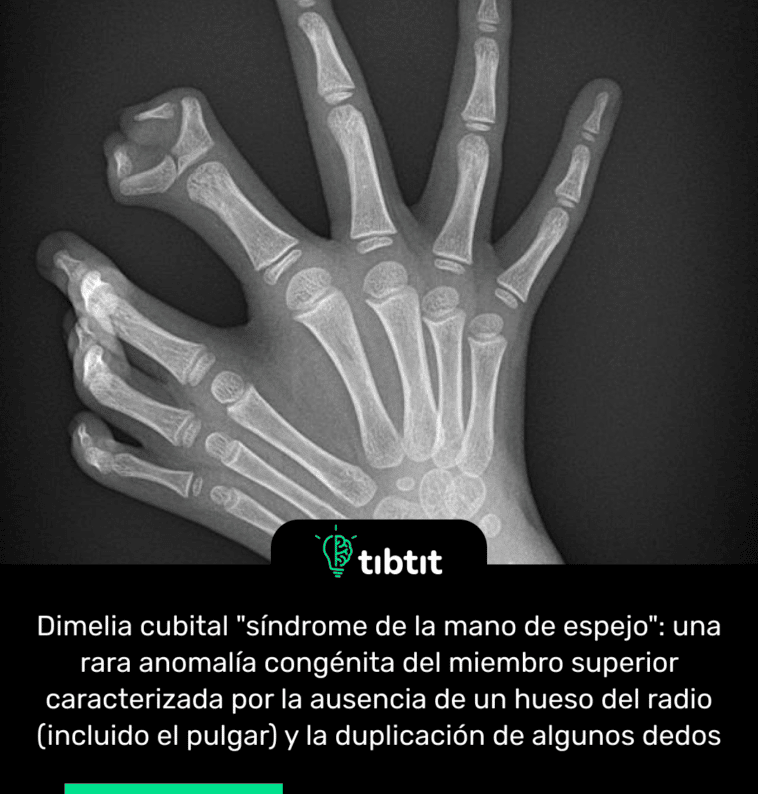 Dimelia cubital "síndrome de la mano de espejo": una rara anomalía congénita del miembro superior caracterizada por la ausencia de un hueso del radio (incluido el pulgar) y la duplicación de algunos dedos