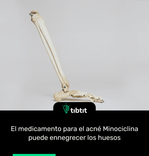 El medicamento para el acné Minociclina puede ennegrecer los huesos