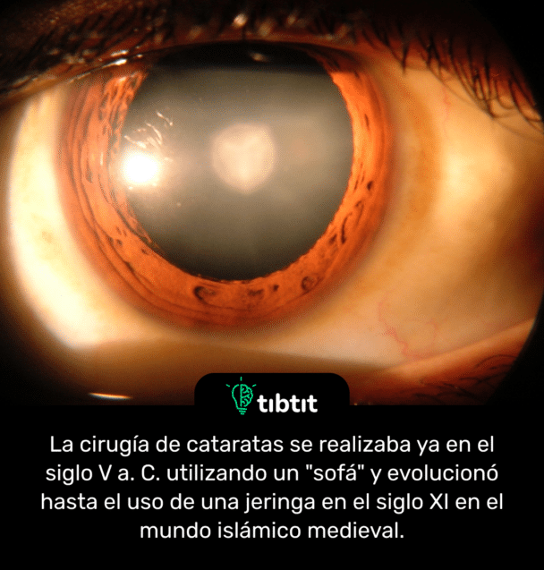 La cirugía de cataratas se realizaba ya en el siglo V a. C. utilizando un "sofá" y evolucionó hasta el uso de una jeringa en el siglo XI en el mundo islámico medieval.
