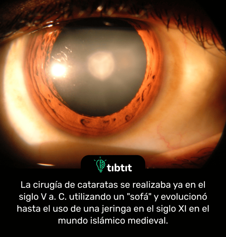 La cirugía de cataratas se realizaba ya en el siglo V a. C. utilizando un "sofá" y evolucionó hasta el uso de una jeringa en el siglo XI en el mundo islámico medieval.
