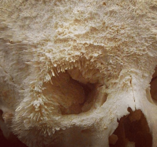 Así es como se ve el cáncer de huesos