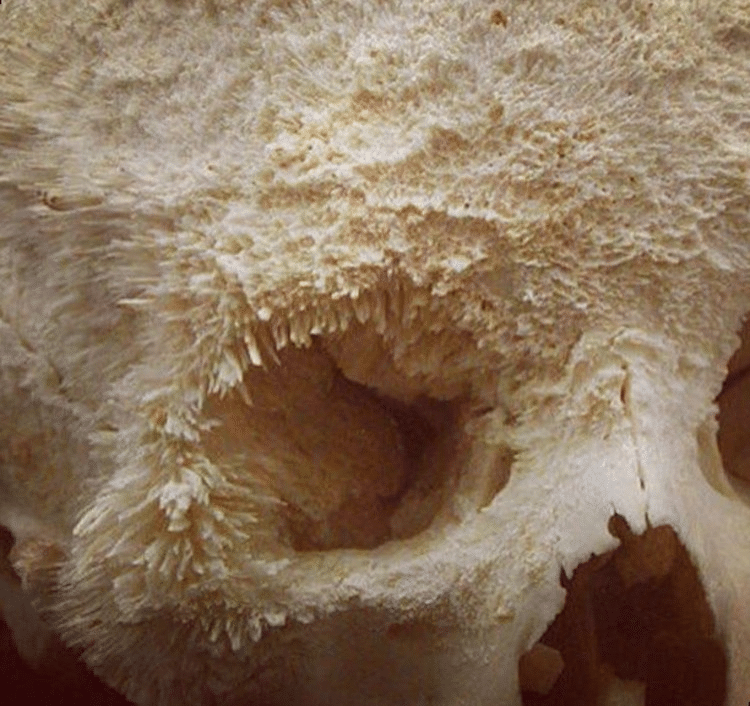 Así es como se ve el cáncer de huesos