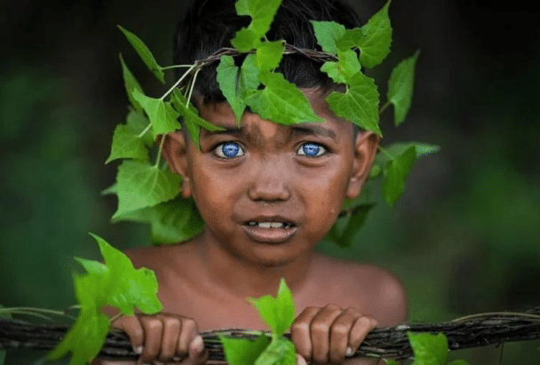 Síndrome de Waardenburg. Una enfermedad genética muy rara
