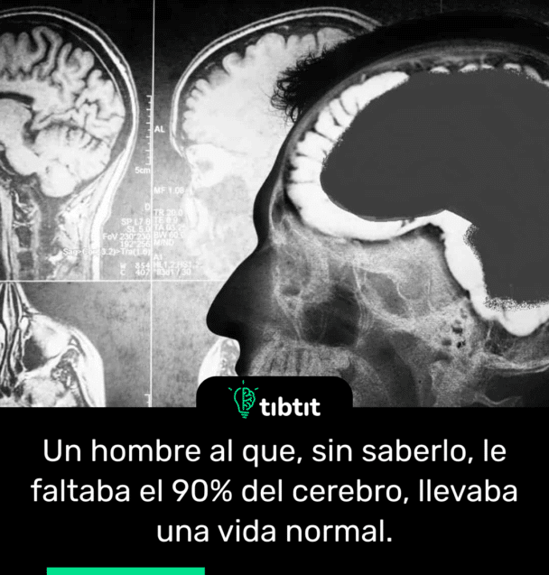 Un hombre al que, sin saberlo, le faltaba el 90% del cerebro, llevaba una vida normal.