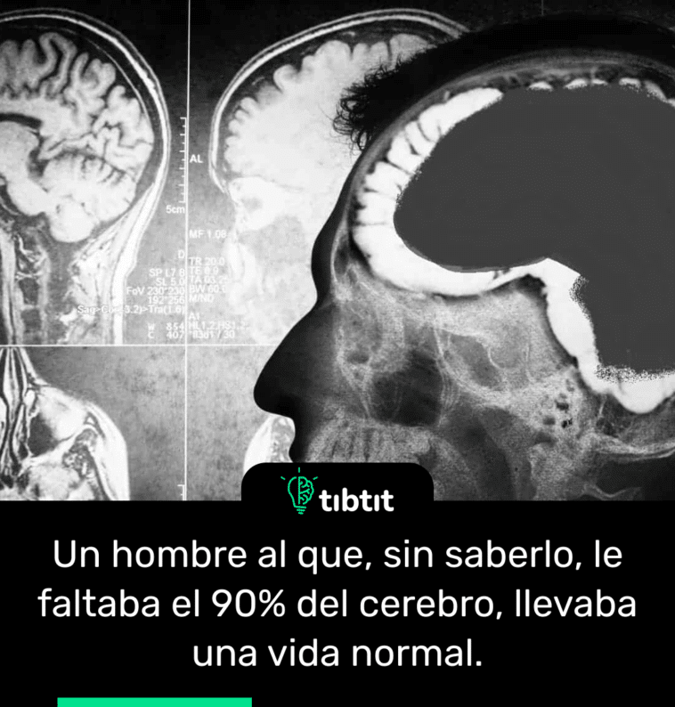Un hombre al que, sin saberlo, le faltaba el 90% del cerebro, llevaba una vida normal.