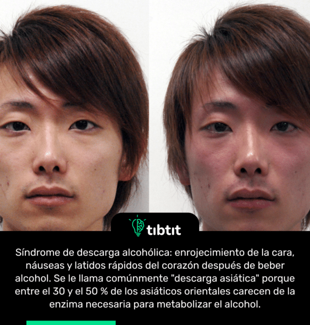 Síndrome de descarga alcohólica: enrojecimiento de la cara, náuseas y latidos rápidos del corazón después de beber alcohol. Se le llama comúnmente "descarga asiática" porque entre el 30 y el 50 % de los asiáticos orientales carecen de la enzima necesaria para metabolizar el alcohol.