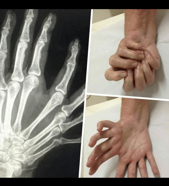 Síndrome de la mano del espejo