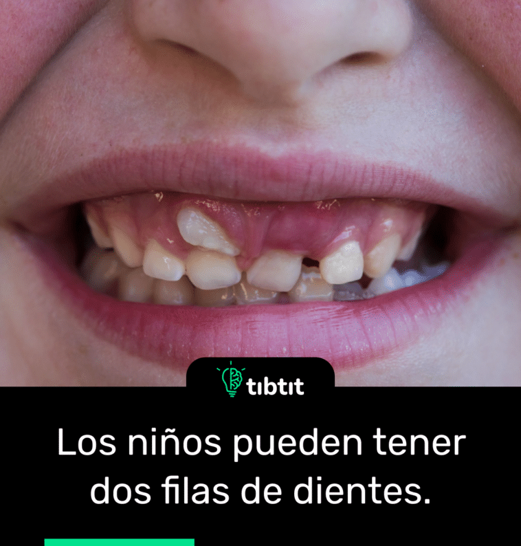 Los niños pueden tener dos filas de dientes.