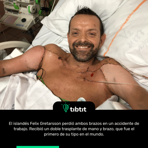 El islandés Felix Gretarsson perdió ambos brazos en un accidente de trabajo. Recibió un doble trasplante de mano y brazo, que fue el primero de su tipo en el mundo.