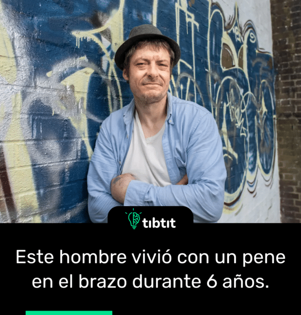 Este hombre vivió con un pene en el brazo durante 6 años.