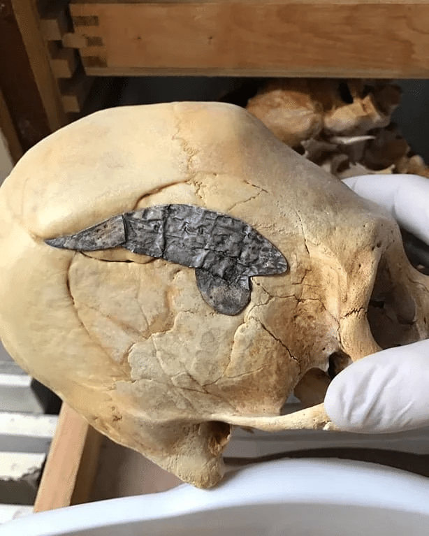 Un cráneo alargado peruano con metal implantado quirúrgicamente después de regresar de la batalla, que se estima que data de hace unos 2000 años. El hueso roto que rodea la reparación está fuertemente fusionado, lo que indica que fue una cirugía exitosa.