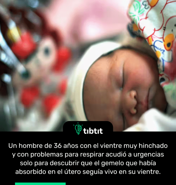 Un hombre de 36 años con el vientre muy hinchado y con problemas para respirar acudió a urgencias solo para descubrir que el gemelo que había absorbido en el útero seguía vivo en su vientre.
