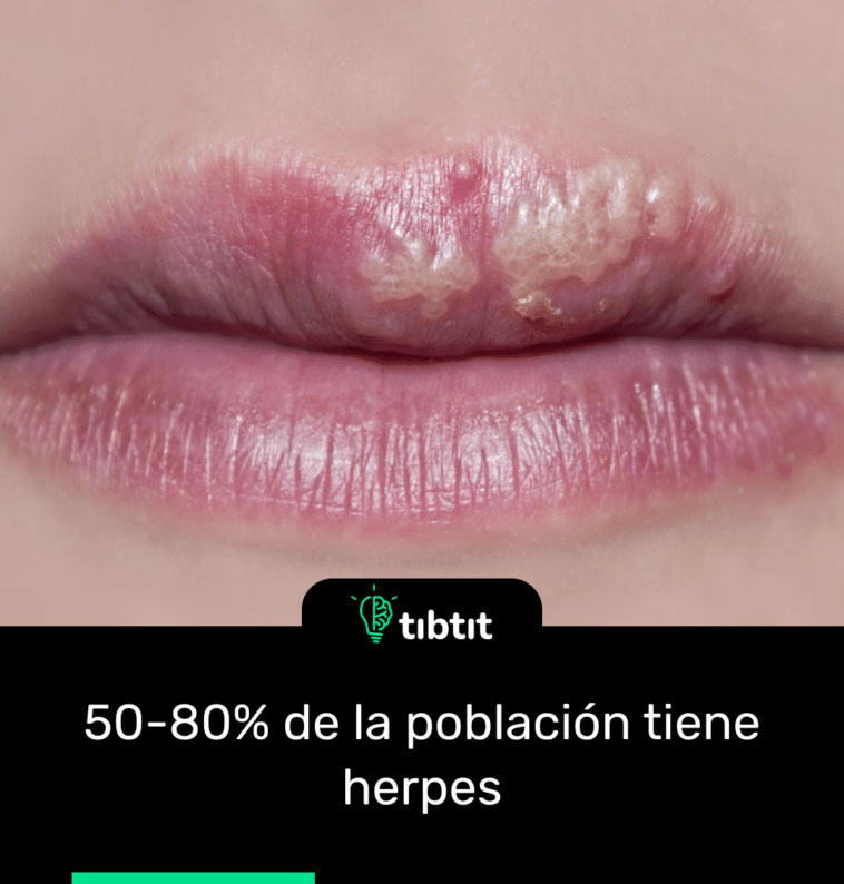 50-80% de la población tiene herpes