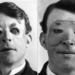 Walter Yeo, una de las primeras personas en someterse a cirugía plástica avanzada e injertos de piel. (1917)